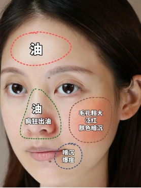 油性皮肤如何祛痘效果好？不长痘的秘诀是什么？
