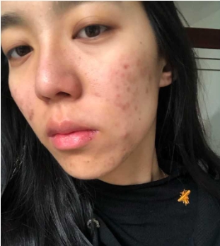 自己如何去除额头的痘痘？怎么最快淡化痘印？