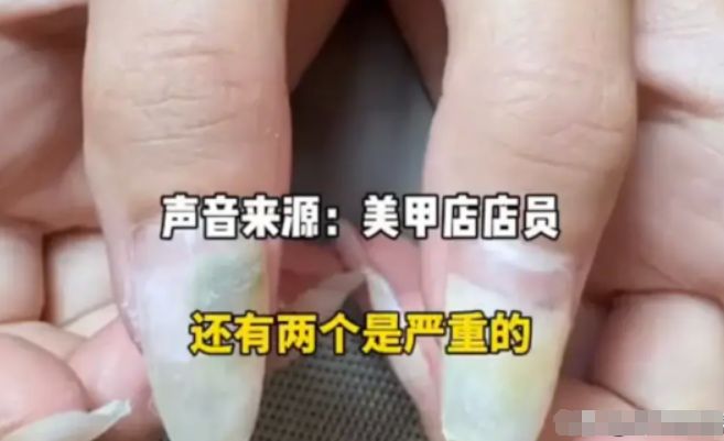 女子卸甲后发现十指空甲发霉，严重感染绿脓杆菌